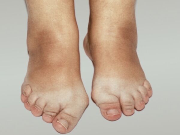 Artrosi del piede con grave deformazione delle dita