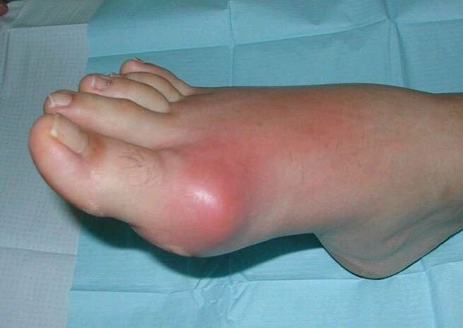 Quadro clinico dell'artrite del piede gonfiore e infiammazione