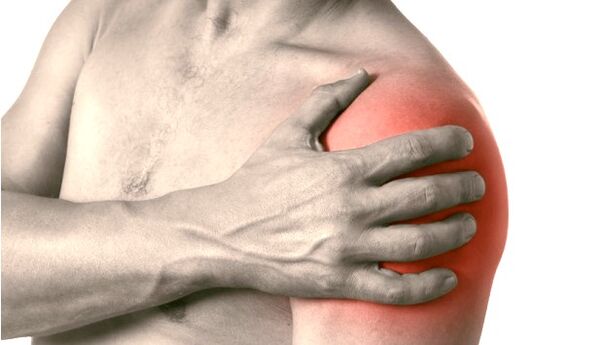 Una spalla gonfia, rossa e ingrossata - sintomi di artrosi dell'articolazione della spalla di grado 2-3