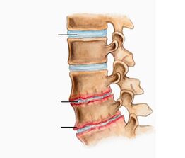 Osteocondrosi