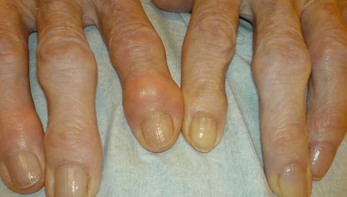 dolore alle articolazioni delle dita con osteoartrite