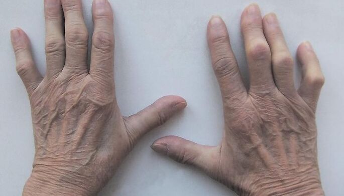 dolore alle articolazioni delle dita