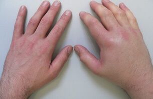 artralgia come causa di dolore alle articolazioni delle dita