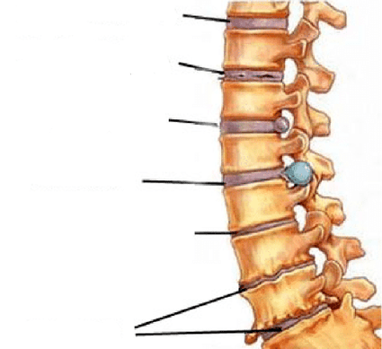 fasi di sviluppo dell'osteocondrosi della colonna vertebrale