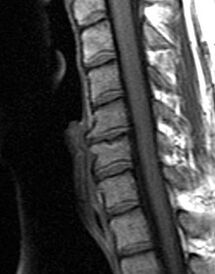 radiografia della colonna vertebrale toracica