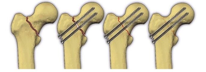 fissazione del corpo osseo con perni per il dolore all'articolazione dell'anca