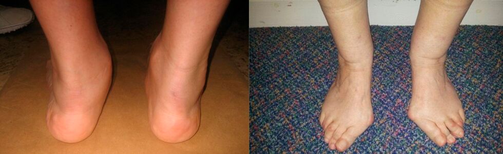 Artrosi dell'alluce e artrosi deformante della caviglia
