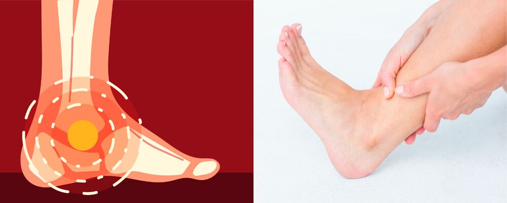 Il dolore nell'artrosi deformante della caviglia è accompagnato da gonfiore, diminuzione della mobilità articolare