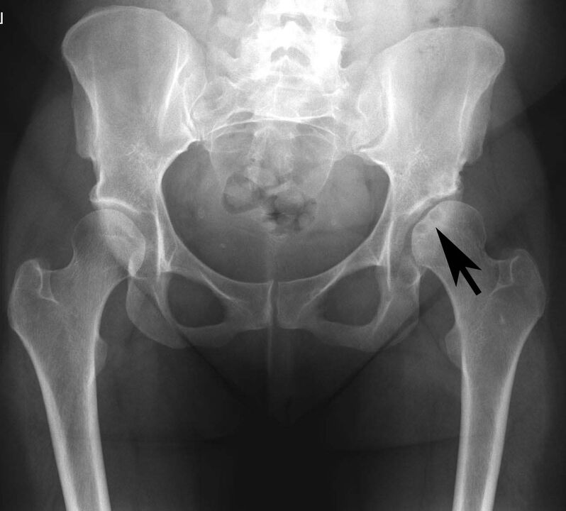 Deposizione di sali di calcio nell'articolazione dell'anca con pseudogotta ai raggi X