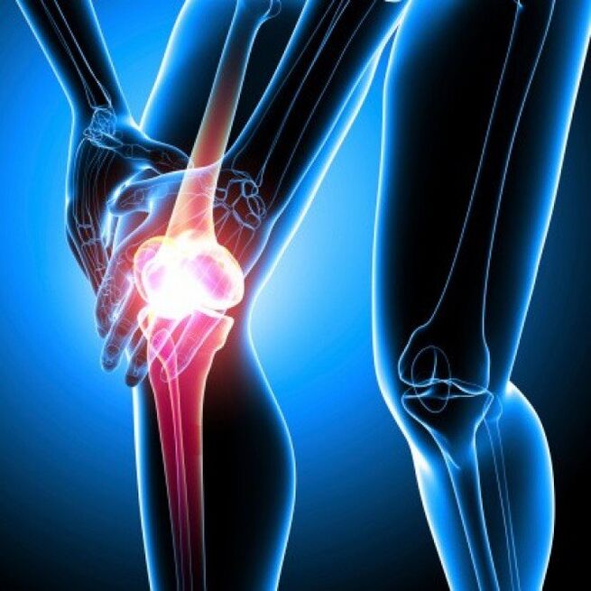 L'artrite reumatoide in stadio avanzato può causare dolore all'anca
