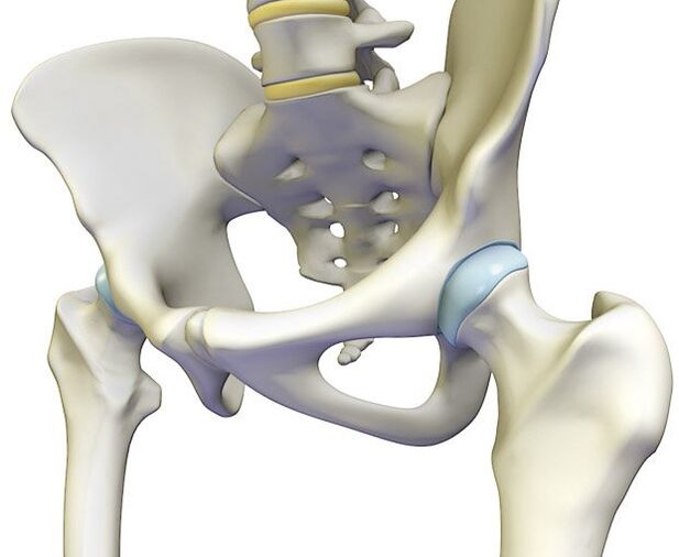 L'osteocondrosi provoca un forte dolore all'articolazione dell'anca
