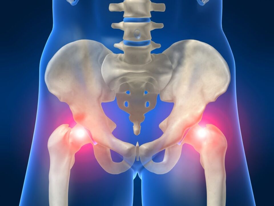 Nella spondilite anchilosante, il dolore bilaterale nell'articolazione dell'anca è inquietante